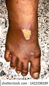 Healing abrasions or ulcer or wound with granulatuon tissues surrounded by scabs and slight cellulitis on the dorsum of right foot in Southeast Asian, burmese, adult male patient.