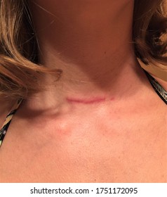 A Healing Scar On A Woman's Neck From Thyroidectomy Surgery Due To Papillary Thyroid Cancer 