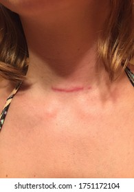 A Healing Scar On A Woman's Neck From Thyroidectomy Surgery Due To Papillary Thyroid Cancer 