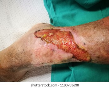 Healing Venous Ulcer Of The Leg With Granulation Tissue.