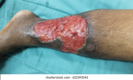 Healing Wound On Varicose Ulcer