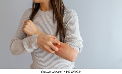 Health Allergy Skin Care Problem. Closeup Young Woman Scratching Her Arm With Allergy Rash. Woman Scratching An Itch . Sensitive Skin, Food Allergy Symptoms, Irritation