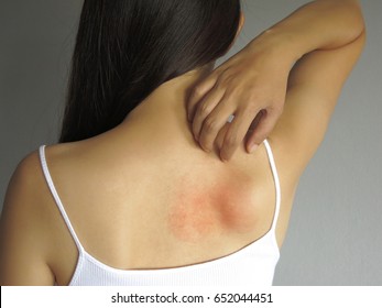 Health allergy skin care problem. Closeup young woman scratching her itchy back with allergy rash - Shutterstock ID 652044451