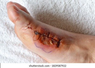Health care and foot surgery, Wound infection after operation, Lesion with hematoma or contusion, Problem of right side feet with a bunion (referred to as hallux valgus or hallux abducto valgus)