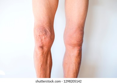 Health Care  Medical,Old man's legs on a white background