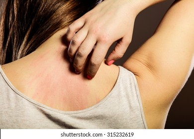 Health problem. Closeup young woman scratching her itchy back with allergy rash