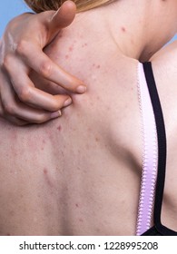 Health problem, skin diseases. Young woman showing her back with acne, red spots. Teen girl scratching her shoulder with pimples.