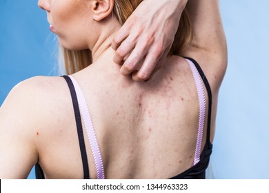 Health problem, skin diseases. Young woman showing her back with acne, red spots. Teen girl scratching her shoulder with pimples.