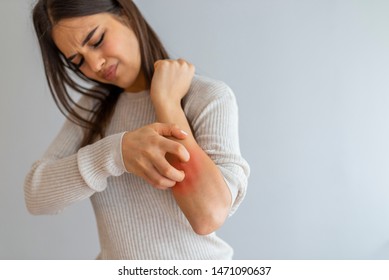 Health Problem, Skin Diseases. Young Woman Scratching Her Itchy Arm With Allergy Rash. Woman Scratching Her Arm. Woman Scratching Arm Indoors, Space For Text. Allergy Symptoms