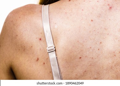 Health Problem, Skin Diseases. Young Woman Showing Her Back With Acne, Red Spots. Teen Girl With Many Pimples.