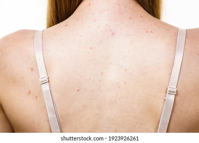 Health problem, skin diseases. Young woman showing her back with acne, red spots. Teen girl with many pimples.