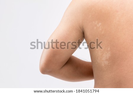 Healthcare concept : Macro white Pityriasis or Tinea Versicolor on back skin. Used for skincare concept