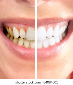Healthy beautiful smile. Dental health. Whitening.