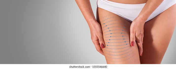 Healthy Elastic Skin On Thigh,  Perfect Skin, Stretchmark, Concept Of Lifting Skin. Fitness Or Plastic Surgery And Aesthetic Cosmetology.