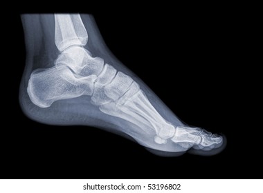 X Ray Foot Images Stock Photos Vectors Shutterstock