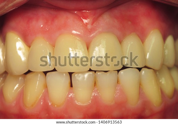 Healthy Teeth Humans Removal Plaque Dental Stock Photo Edit