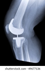 Healthy Total Knee Joint Replacement On X-ray With Black Background