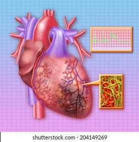 Heart Attack With Blood Clot