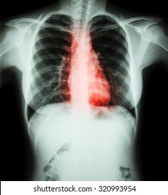 Heart Disease ( Film Chest X-ray Of Woman With Heart Disease )