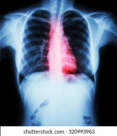 Heart Disease ( Film Chest X-ray Of Woman With Heart Disease )