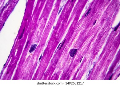 Heart Hypertrophy, Histopathology. Photomicrograph Showing Hypertrophic Myocardium With Thick Muscle Fibers And Enlarged And Dark Nuclei. High Magnification