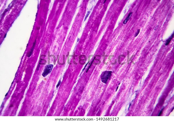 Heart hypertrophy, histopathology.\
Photomicrograph showing hypertrophic myocardium with thick muscle\
fibers and enlarged and dark nuclei. High\
magnification