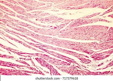 Heart Hypertrophy. Photomicrograph Showing Hypertrophic Myocardium With Thick Muscle Fibers And Enlarged And Dark Nuclei