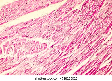 Heart Hypertrophy. Photomicrograph Showing Hypertrophic Myocardium With Thick Muscle Fibers And Enlarged And Dark Nuclei