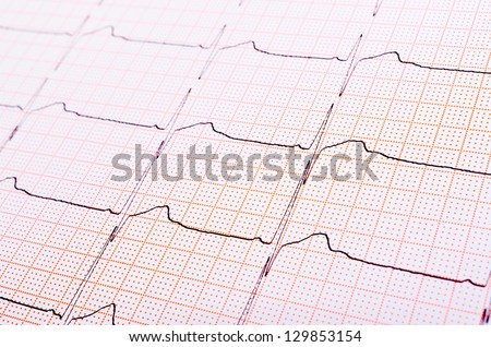 Heart Rhythm Chart