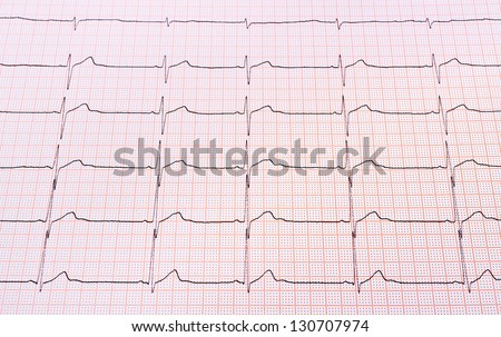 Heart Rhythm Chart