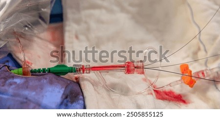 Heart stent placement process in operating room. Heart doctor inserting central venous catheter, Jugular venous catheterization. A central venous catheter is inserted into the jugular vena.