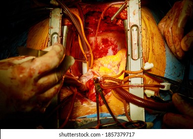 Heart Surgeon Doctor Operation Heart Surgery Intervention Replace Valve Open Cord Surgery Minimally Invasive Surgery