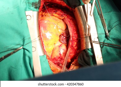 Heart Surgery