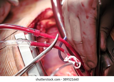 Heart Surgery With Cardiopulmonary Bypass Macro
