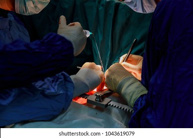 Heart Surgery. Open Heart Surgery. Coronary Artery Bypass Surger