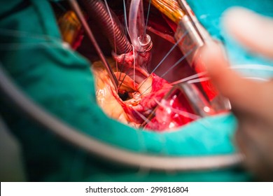 Heart Surgery In Operating Room