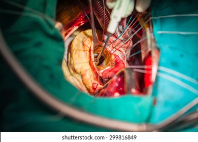 Heart Surgery In Operating Room