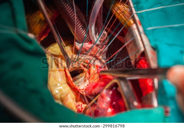 Heart surgery in operating\
room