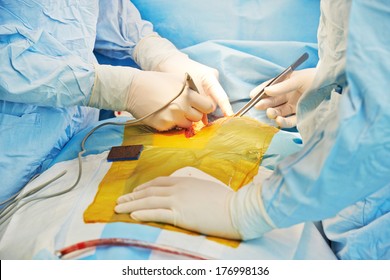 Heart Transplantation. Human Heart In Surgeon Hands During Cardiac Surgery Operation