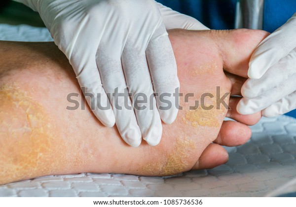 Heel Break Bad Smellbed Patient Stock Photo Edit Now 1085736536