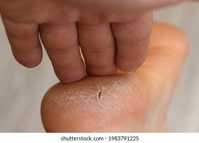 Heel Cracked Skin on man's foot.