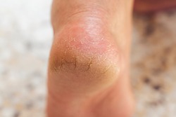 The dry skin on the heel is cracked. Closeup dehydrated skin on the ...