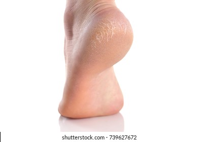 The Heel Of The Foot With Bad Skin Is Covered With Cracks