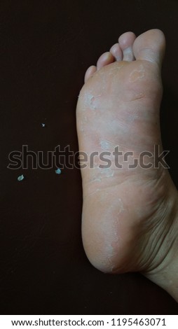 Heel skin, fungal skin disease
