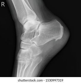 Heel Spur On The X-ray Of The Right Heel Bone