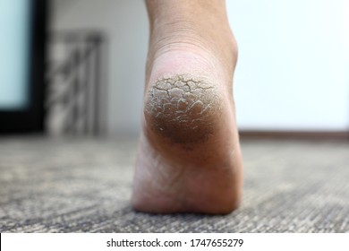 Rough Feet Images, Stock Photos & Vectors - Shutterstock