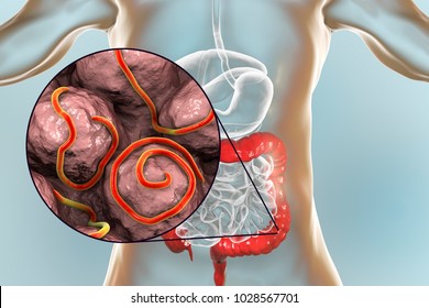 Helminths nematodes Enterobius in the gut. Threadworm which causes enterobiasis, 3D illustration showing close-up view of threadworms located in large intestine