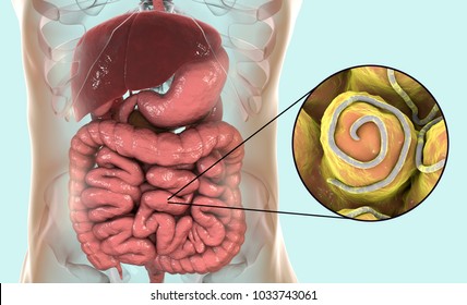 Helminths nematodes Enterobius in the gut. Threadworm which causes enterobiasis, 3D illustration showing close-up view of threadworms located in large intestine