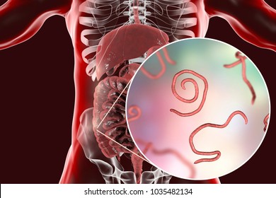 Helminths nematodes Enterobius in the gut. Threadworm which causes enterobiasis, 3D illustration showing close-up view of threadworms located in large intestine