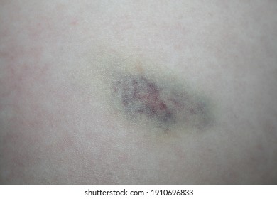 Hematoma Bruise On Body After Blow Stock Photo 1910696833 | Shutterstock